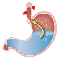 逆流性食道炎の診療