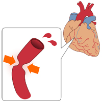 狭心症の診療